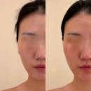 경락마사지 | 옆광대축소술 주사 후기보다 좋은 경락마사지 후기