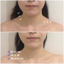 유니메디컬 | 연산동피부관리 &#34;유니유에스테틱&#34; 리프팅 3V윤곽관리 후기 🪞