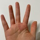 역곡 맑은석피부과 진료 후기 (한포진,접촉성피부염)