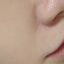 한불피부이야기 | 대구 편평사마귀 제거 | 통증없이 3일 만에 회복한 내돈내산 후기