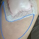 (유)서현 | 허벅지 표피낭종 피지낭종 제거 수술 서현역 더유외과 수술 후기