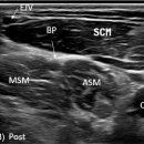 4.LEVEL IV: LOWER JUGULAR NODES 이미지