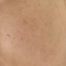 세종스노우의원 | 세종 스노우의원 기미/잡티 프리미엄 패키지 10회차까지 다 받은 찐 후기(피코토닝, 아이스 레이저)