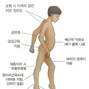 S0140 | 듀시엔형 근이영양증 (Duchenne Muscular Dystrophy, DMD)