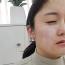 구미 인셀덤 보타랩