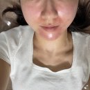 DDR | 동탄피부과 편평사마귀 제거 여드름 홍조 피지 PDT DDR 네오빔 후기