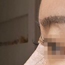 코보소 | 비염/비중격만곡증 수술 기능코 + 미용코(실리콘x) 후기1탄