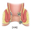 치질인줄 알았는데 (간과하기 쉬운 대장암 징후) 이미지