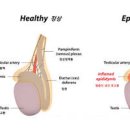 고환 통증 원인 증상 치료 남자 왼쪽 고환 통증 오른쪽 고환 통증 이미지