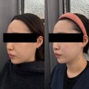 수원 리프팅맛집 ‘닉스의원’ 티타늄 리프팅 내돈내산 후기