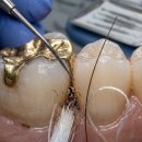 용인선플란트치과의원 | 용인 치과 추천 , 10년 전 씌운 금니에서 냄새가 난다면?