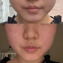 대구웨딩관리 비대칭 및 얼굴형 고민 1회만에 효과본 결다온 대구점