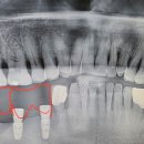 임플란트 시술일지 이미지