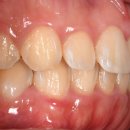 평촌이생각치과의원 | 평촌역 라미네이트 잘하는 곳, 어떻게 고를까요?