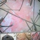 강서구-40 | 강서구두피관리, 40대 후반 남성 지루성 두피염으로 인한 각질, 가려움 알알 후기 ( 9회차 )