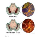 파킨슨병 장기적인 관리에 침치료가 좋습니다.