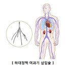 심부정맥 색전증 이미지