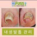 하이푸스 네일조아 응암점 / 발 영양케어 페디큐어 리뷰