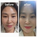 뷰 성형외과 눈성형 후기 <메타골드 가맹점>