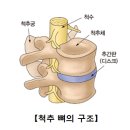 요추 추간판 탈출증(Herniation of intervertebral disk) 이미지