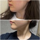 센텀 리프팅 엑셀웨이브 리얼후기(이중턱 제거 효과와 시술 전후 총정리)