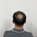 대전두피 대전SMP [도트바이림] 남자정수리탈모 1회 솔직후기
