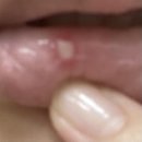 충무오토바이 | 오토바이 사고로 인한 뇌출혈 &amp; 안와 골절 진단 후기 남기기