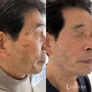 남포동루미에르 | 얼굴의 잡티, 흑자, 검버섯 고민, 남포동 루미에르에서 해결하세요!