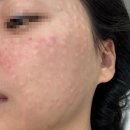 건조한 복합성피부가 맞은 리쥬란HB(4cc)후기(리쥬란힐러 차이, 통증, 효과시기)