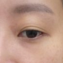 하얀J피부과의원 | 문의원 눈밑필러 다크써클필러 1차 후기