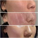 클리어레이저 | 홍대피부과 여드름 흉터 모공 종결 레이저, 울트라클리어 레이저 후기 여드름 흉터 모공 관리 효과 비용...