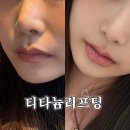 뽀얀피부과의원 | [강남피부과전문의 잘하는곳] 리쥬란힐러 써마지비용 고민대신 티타늄리프팅추천 (통증, 후기)