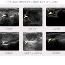 갑상선 결절 &amp; 물혹 갑상선암 증상일까? 이미지