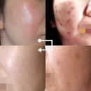 신생사 | 브이빔 레이저 진짜 효과의 한계, 부작용 없이 홍조 잡는법