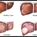 간염에 관한 내용(읽어보세요) 이미지