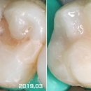 플러스유치과기공소 네이버블로그