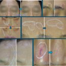 메디서브 | 얼굴 함몰·패인흉터 유착흉터 치료후기ㅣ서브시전+피코프락셀+미라젯 복합치료효과(165번째사례)