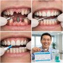 노벨치과의원 | 임플란트 가격 비교 및 시술 과정 총정리 | 치과위생사가 알려주는 현실 가이드