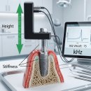 세계로치과의원 | 기흥 임플란트 치과 , ISQ 임플란트 수치의 중요성