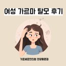 과천한의원 | 여성 가르마탈모 6개월 치료 후기 (안양 군포 의왕 과천 탈모 피부과 한의원)