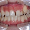 선이아름다운치과교정과치과의원 | [의왕치과/오전동치과] 발치 없이 심한 덧니 해결! 악궁확장장치를 이용한 비발치교정 A to Z