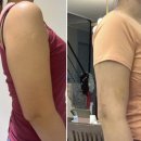 40대 팔뚝 지방흡입 후기 준비물 당일 통증 붓기