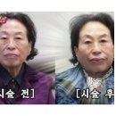서우림 | 전원주, 500만원 피부과 시술 후 확 달라졌다..."주름 없이 매끈해져"