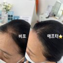 혜민헤어 - 전주시 완산구 | [사당탈모관리] 혜민웨이 :: 50대 헤어라인 문신 후기(feat.통증, 관리법, 리터치)