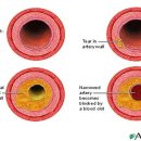 Coronary Artery Disease 이미지