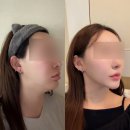 비너스사우나 | 비너스 달걀주사 맞고 투턱 이중턱 없앤 솔직후기