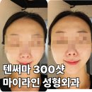 예쁜라인성형외과의원 | 텐써마 300샷 효과 통증 신사역 마이라인성형외과내돈내산 후기