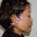 거상환경 | 안면거상 부작용 사례 및 종류 + 회복기간 줄이는 법(후기 좋은 치료)