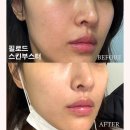 힘나는병원 | 속건조에 리쥬란보다 효과 좋은 필로드 스킨부스터 강남 피부과