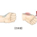 손 건초염(Tenosynovitis) 증상과 치료 이미지